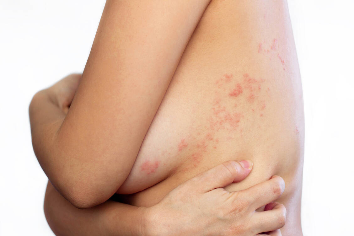 Bei einer Erstinfektion einer Schwangeren mit Varizella-Zoster-Viren können die Viren auf das Ungeborene übergehen und dieses schwer schädigen. Dagegen bereitet ein Herpes zoster meist keine Probleme für das Kind. / Foto: Adobe Stock/Marina Demeschko