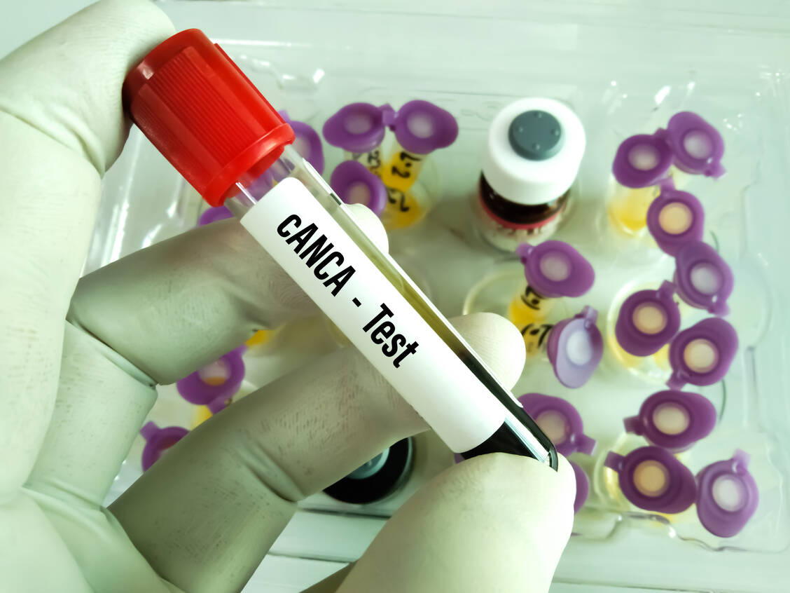 Der cANCA-Test ist für die Diagnostik der Granulomatose mit Polyangiitis wichtig. Zur Diagnose der mikroskopischen Polyangiitis dient der pANCA-Test. Beide Erkrankungen zählen zu den ANCA-Vaskulitiden. / Foto: Adobe Stock/Arif Biswas