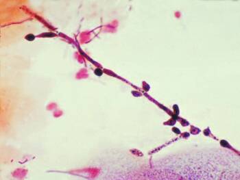 Was in der Vagina für heftigen Juckreiz sorgt, ist in der Laboruntersuchung fast hübsch anzuschauen, wie diese Abbildung zeigt: Candida albicans im Vaginalabstrich.
<p class="fotonachweis">Foto: CDC/Dr. Stuart Brown</p>