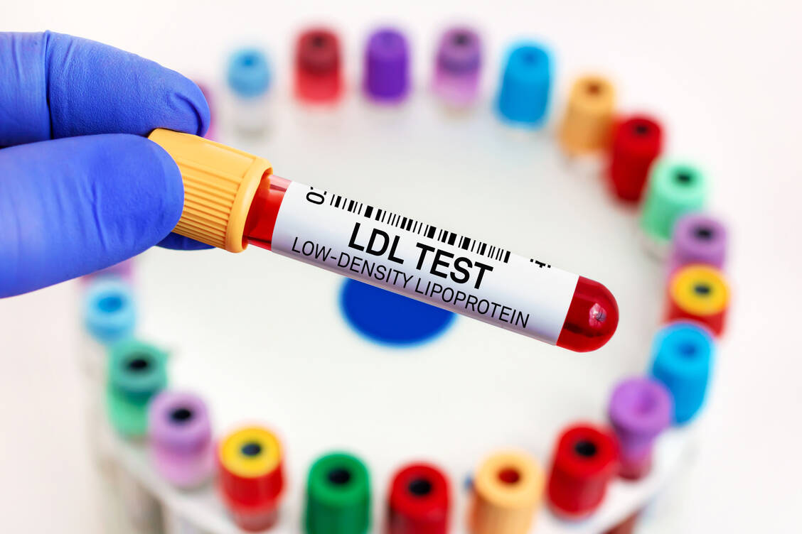 LDL-Cholesterol ist in den Prozess der Atherosklerose-Entwicklung involviert. Auch Lipoprotein a wirkt atherogen. Anders als LDL-Cholesterol ist es bisher aber pharmakotherapeutisch nicht ausreichend adressierbar. / Foto: Adobe Stock/angellodeco