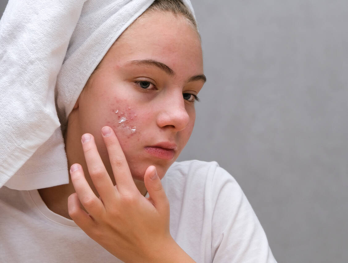 Die Creme Winlevi soll zweimal täglich dünn auf die von Akne betroffenen Stellen aufgetragen werden. / © Getty Images/Yuliya