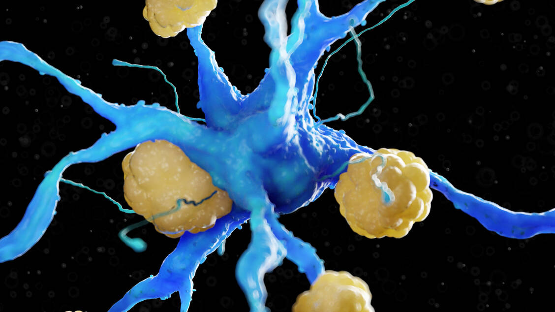 Im Gehirn von Alzheimerpatienten lagern sich β-Amyloid-Peptide zu Oligomeren und schließlich zu Fibrillen zusammen die letztlich sichtbare Amyloid-Plaques bilden. / Foto: Getty Images/Sebastian Kaulitzki/Science Photo Library