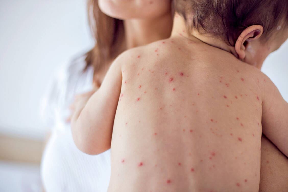 Masern sind keine harmlose Kinderkrankheit. / Foto: iStock/South_agency