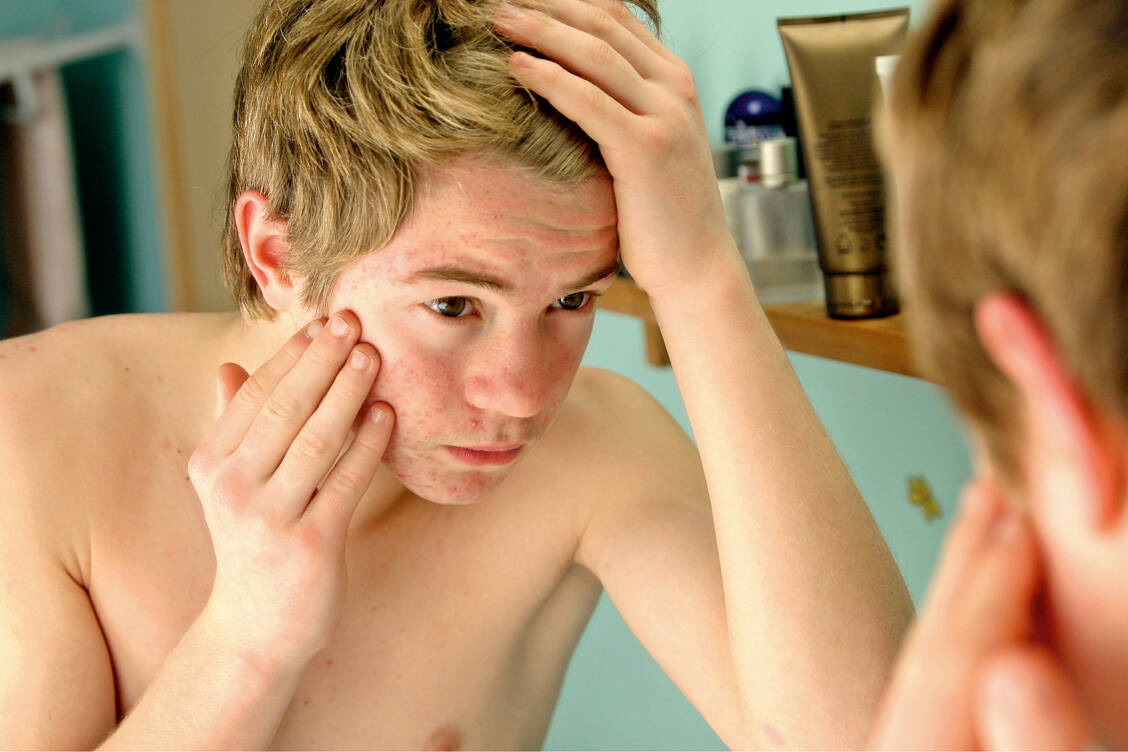 Im Teenageralter lässt Propionibacterium acnes die Pickel sprießen. Neue Studien zeigen, dass es auch an der Entstehung von Prostatakrebs beteiligt sein kann. / Foto: Your Photo Today