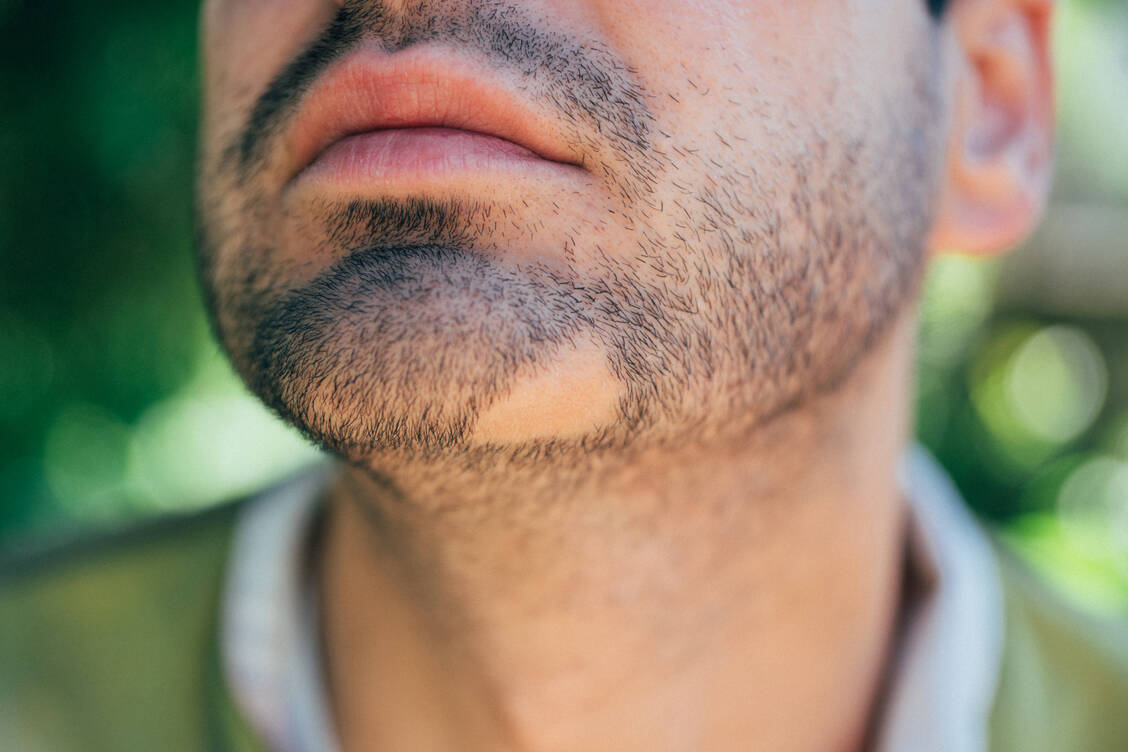 Auch der Bart kann von Alopecia areata betroffen sein. / © Getty Images/VioletaStoimenova