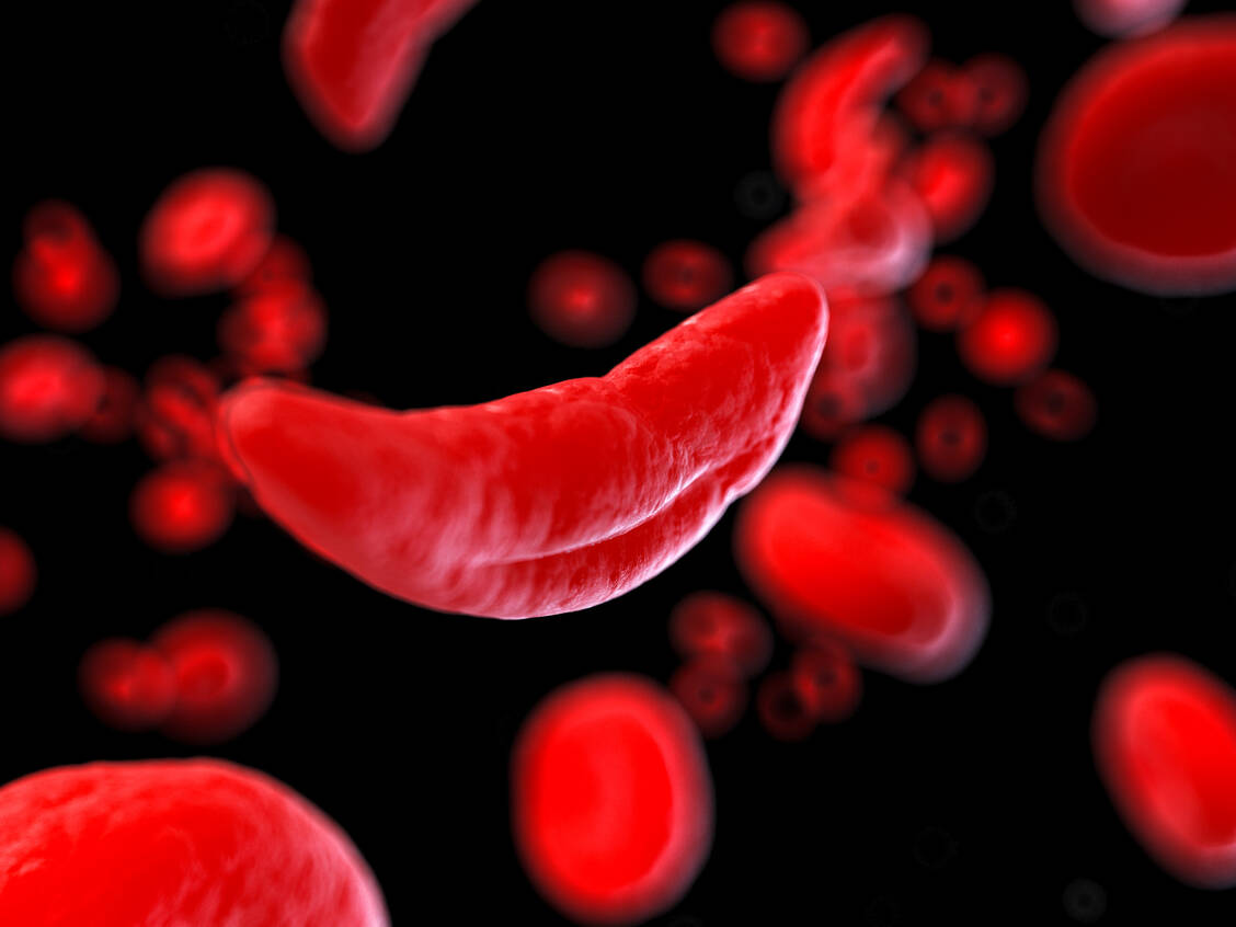 Menschen mit Sichelzellanämie bilden aufgrund eines Gendefekts sichelförmige, starre Erythrozyten statt runde, elastische – mit schwerwiegenden Folgen. / Foto: Adobe Stock/ SciePro