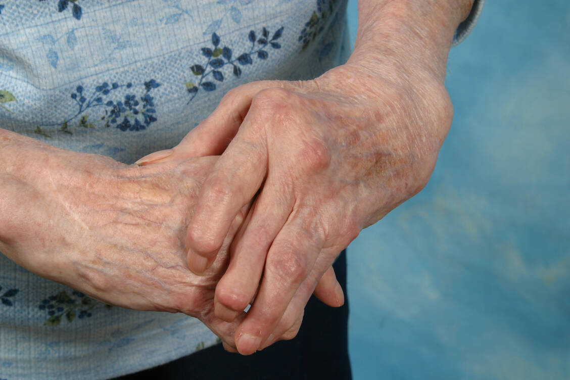Bei Autoimmunerkrankungen wie der rheumatoiden Arthritis ist das Immunsystem zu aktiv und richtet sich gegen körpereigene Strukturen. / Foto: Getty Images/StanRohrer