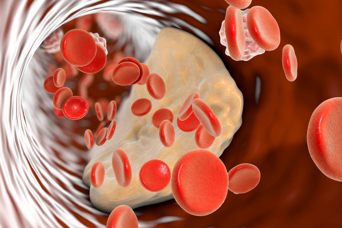 Die Atherosklerose ist auch ein entzündlicher Prozess. Reine Entzündungshemmer zur kardiovaskulären Prävention haben aber bislang enttäuscht. / Foto: Getty Images/Kateryna Kon/Science Photo Library