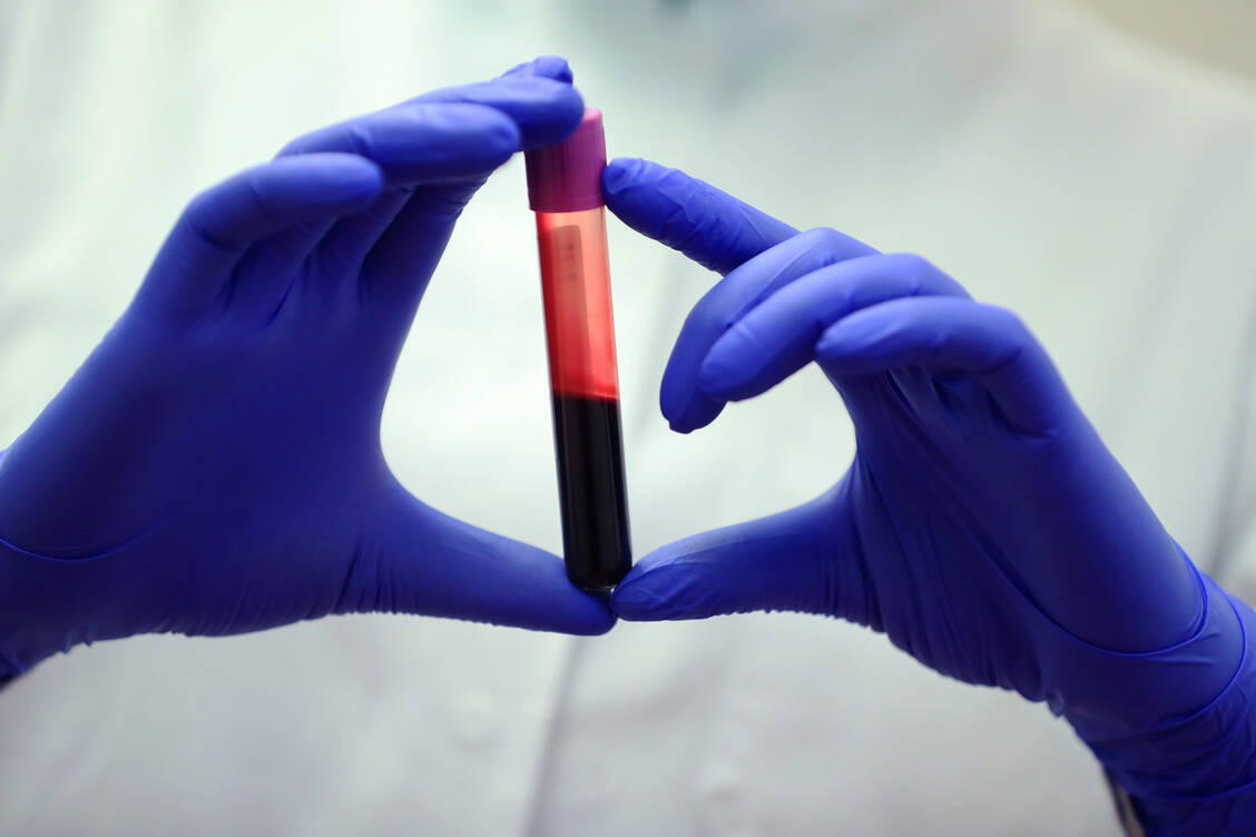Bei der paroxysmalen nächtlichen Hämoglobinurie greift ein Teil des Immunsystems die eigenen Erythrozyten an und zerstört sie. Betroffene Patienten leiden an Anämie. / Foto: Getty Images/Bloomberg Creative
