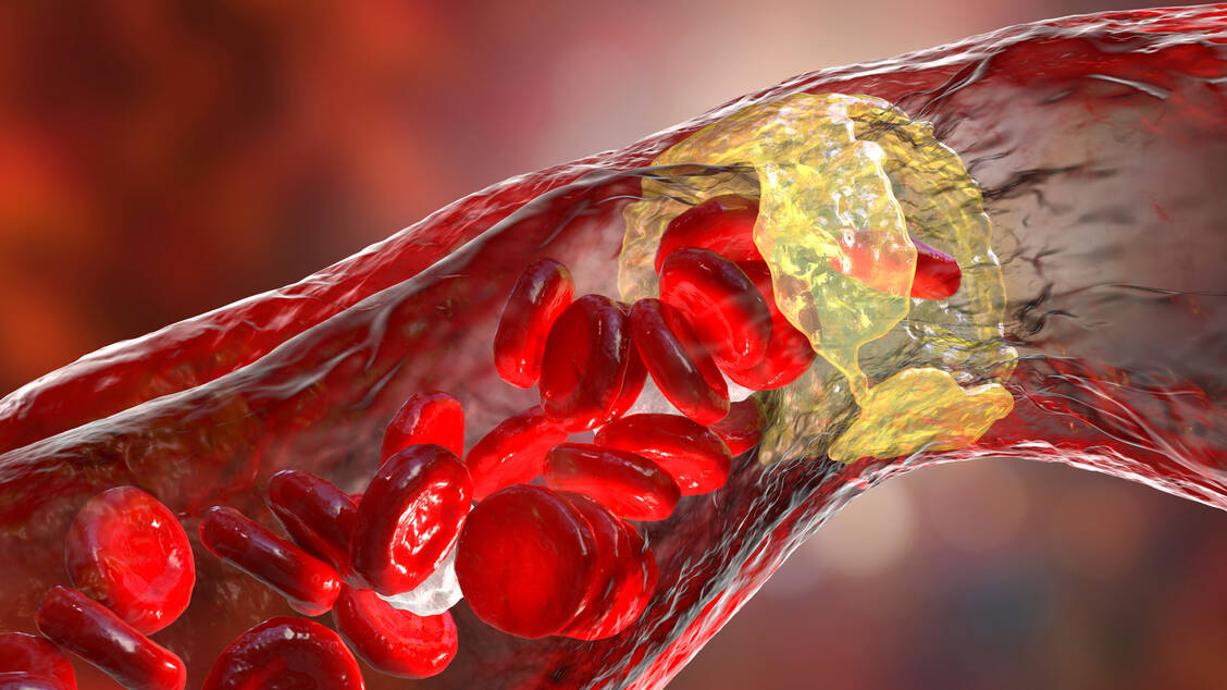Frauen haben im Schnitt kleinere und weniger arteriosklerotische Plaques als Männer, aber deswegen nicht weniger Herz-Kreislauf-Ereignisse wie Herzinfarkt.  / © Adobe Stock/Kateryna_Kon
