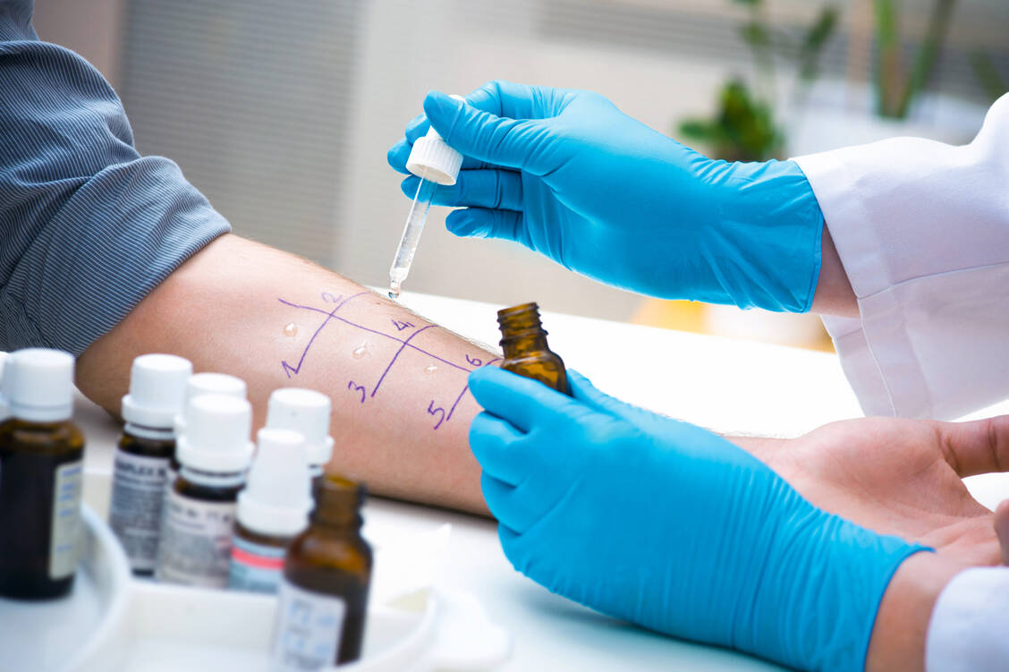 Pricktests zeigen eine Sensibilisierung auf bestimmte Antigene wie Kuhmilcheiweiß an.  / Foto: Shutterstock/Alexander Raths