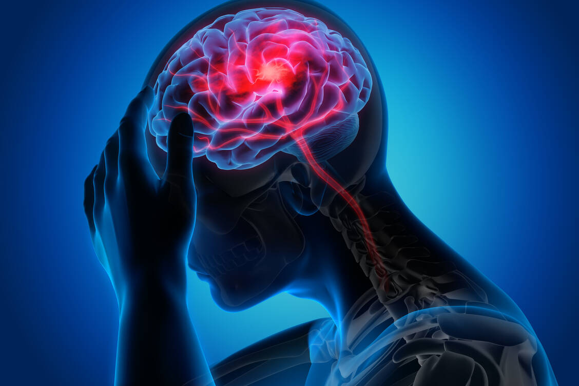 Dem ischämischen Schlaganfall liegt eine Minderung der lokalen Blut- und damit Sauerstoffversorgung im Gehirngewebe zugrunde. / Foto: Adobe Stock/peterschreiber.media