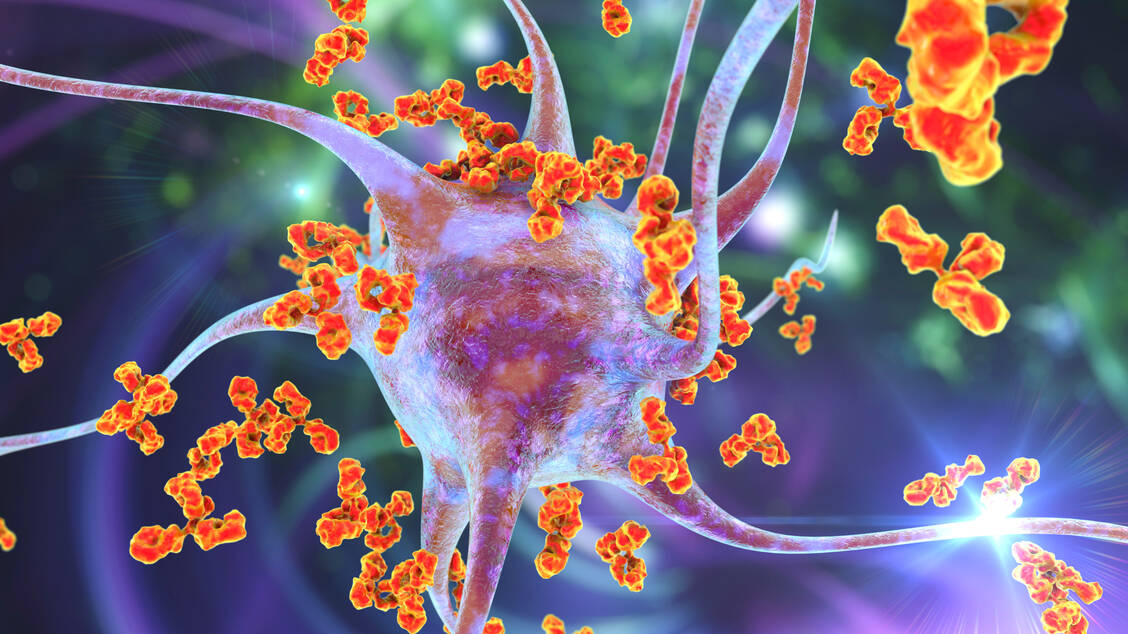 Lecanemab bindet an Amyloid-beta-Verklumpungen, die sich bei Alzheimer-Patienten außerhalb der Nervenzellen im Gehirn bilden, und sorgt so für deren Abbau. / Foto: Getty Sciences/Science Photo Library/Kateryna Kon