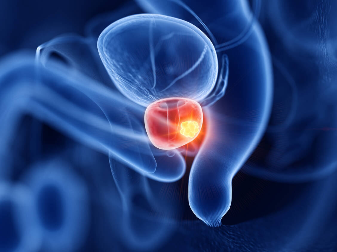 Das neue Medikament erkennt über seinen Ligand-Anteil das Prostata-spezifische Membranantigen, welches Prostatakrebszellen exprimieren und bindet darüber an die Tumorzelle. Diese nimmt den Arzneistoff auf, woraufhin das Lutetium präzise seine Strahlung abgeben kann. / Foto: Adobe Stock/SciePro