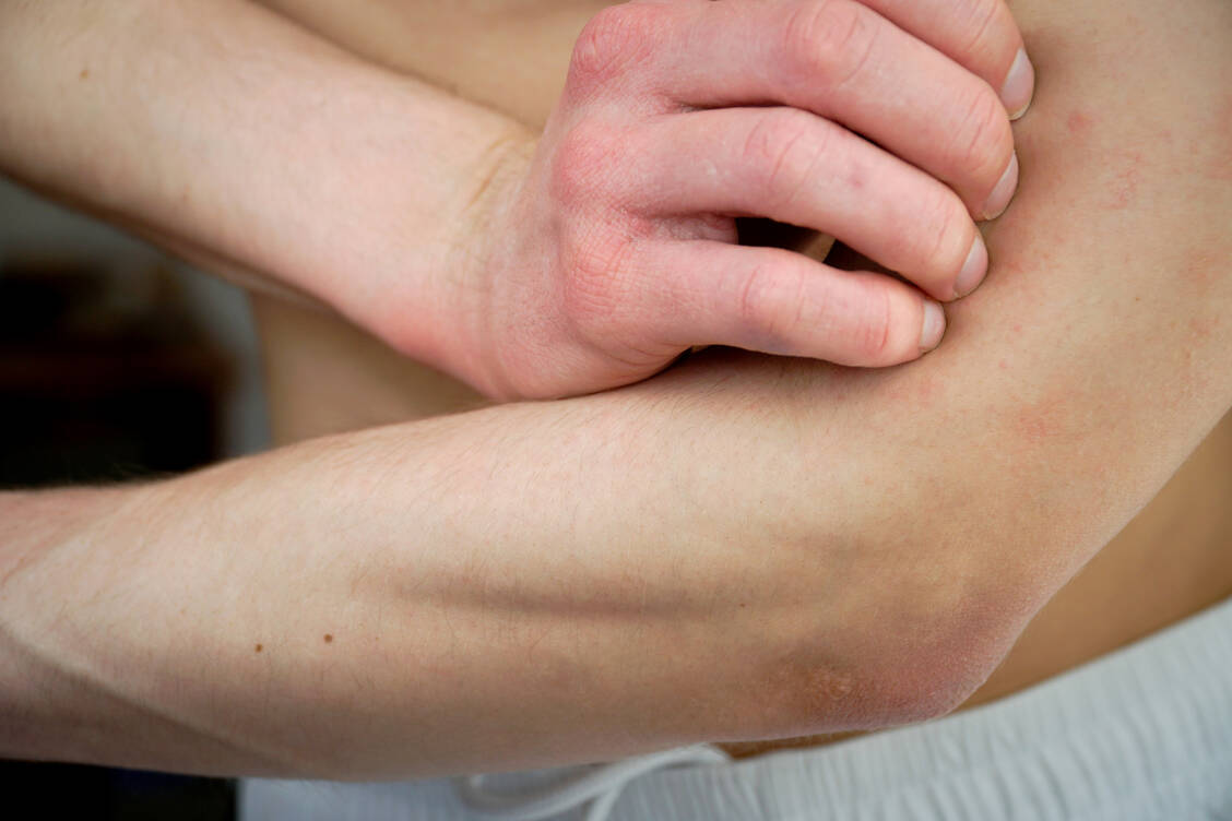 Für Erwachsene mit ausgeprägter atopischer Dermatitis sind meh­rere JAK-Inhibitoren, darunter Baricitinib und Abrocitinib, zuge­lassen. / Foto: Adobe Stock/Georg