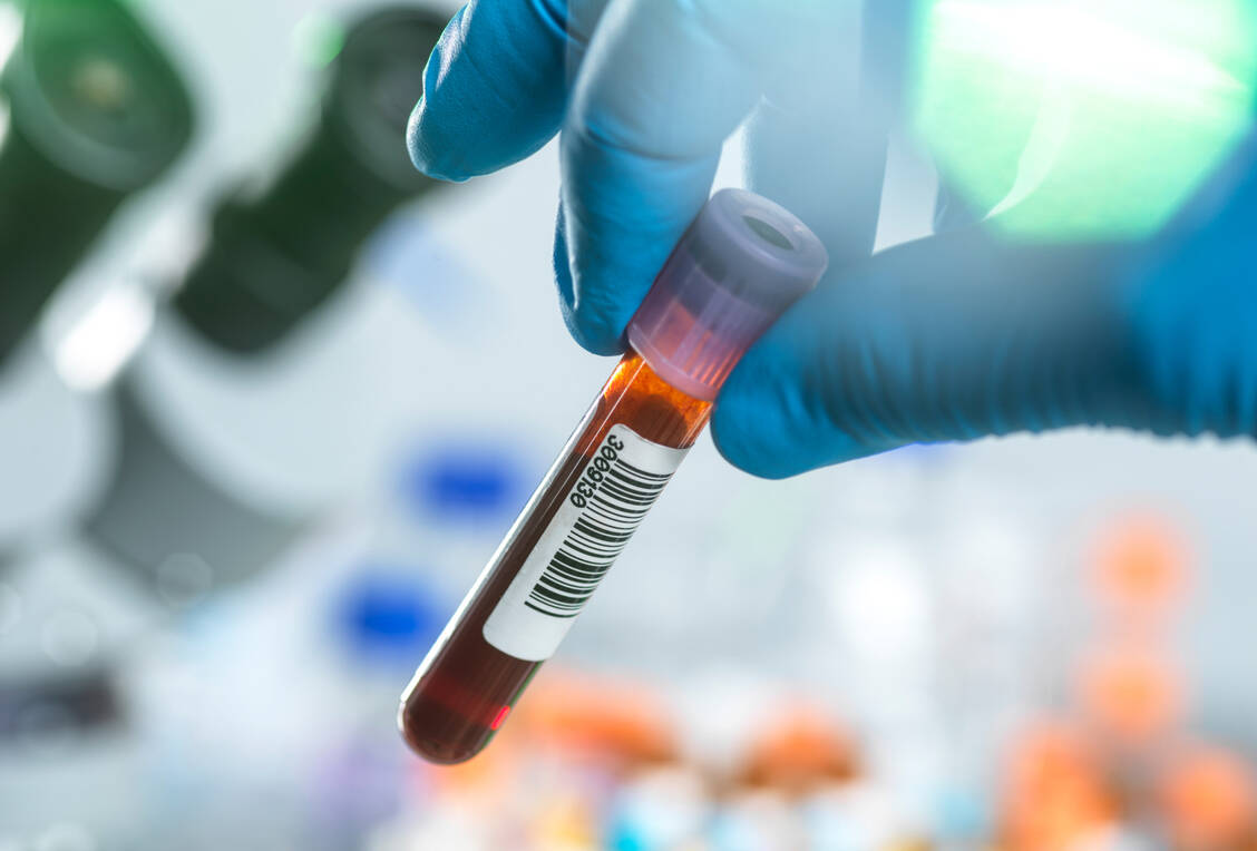 Bei Patienten mit paroxysmaler nächtlicher Hämoglobinurie zerstört das körpereigene Komplementsystem die Erythrozyten. Die Folgen sind Hämolyse und Anämie, aber auch erhöhte Thromboseneigung. / Foto: Getty Images/TEK IMAGE/Science Photo Library