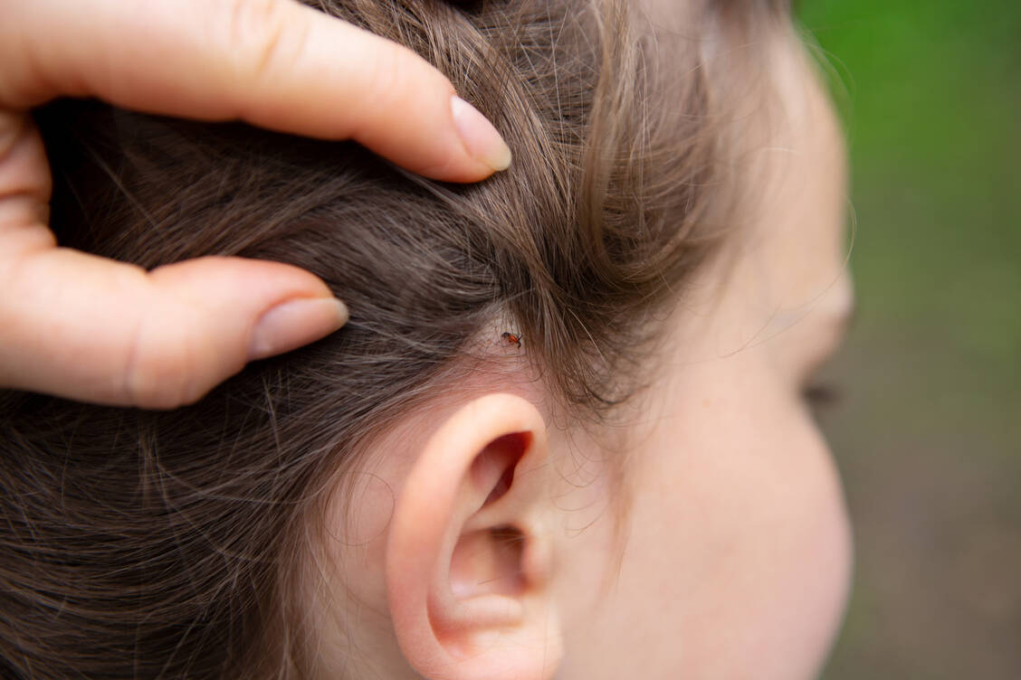 Besonders am Haaransatz lassen sich Zecken gern nieder.  / Foto: Adobe Stock/Anna Ritter