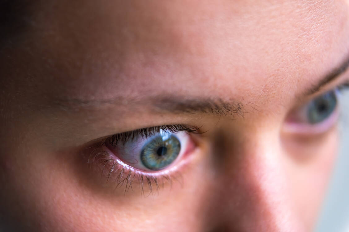 Die hervortretenden Augäpfel bei Morbus Basedow werden als endokrine Orbitopathie bezeichnet. / Foto: Adobe Stock/Andriy Blokhin