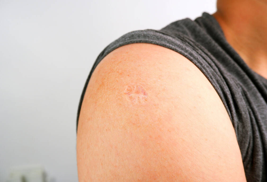 Die Narbe am Oberarm vieler Erwachsener zeugt von der Impfung gegen Pocken, die die Weltgesundheitsorganisation 1967 startete. / © Shutterstock/BLKstudio