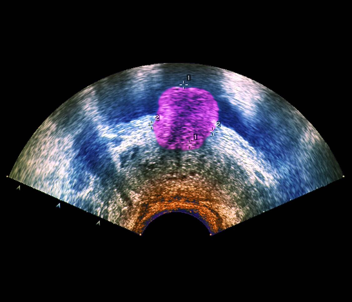Ein Prostata-Tumor im Ultraschall.  / Foto: Imago/Science Photo Library