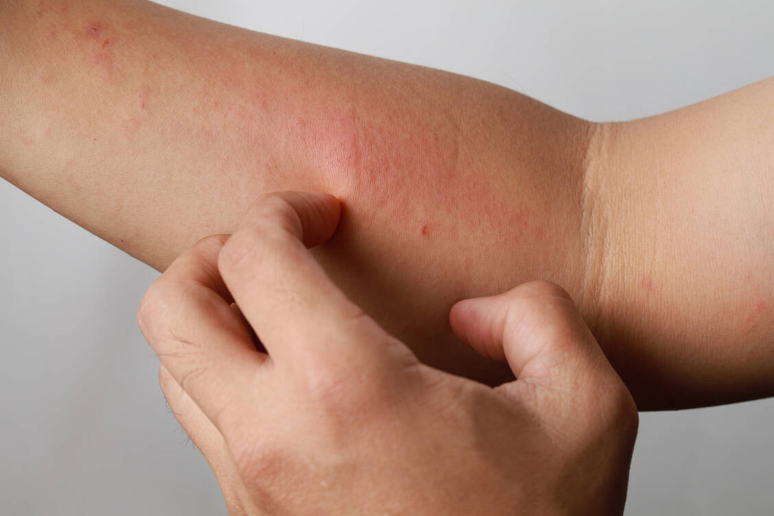 Eine gestörte Hautbarriere ist vielen dermatologischen Erkrankungen gemein. Um so wichtiger ist eine ausreichende Basispflege. / © Adobe Stock/ltyuan