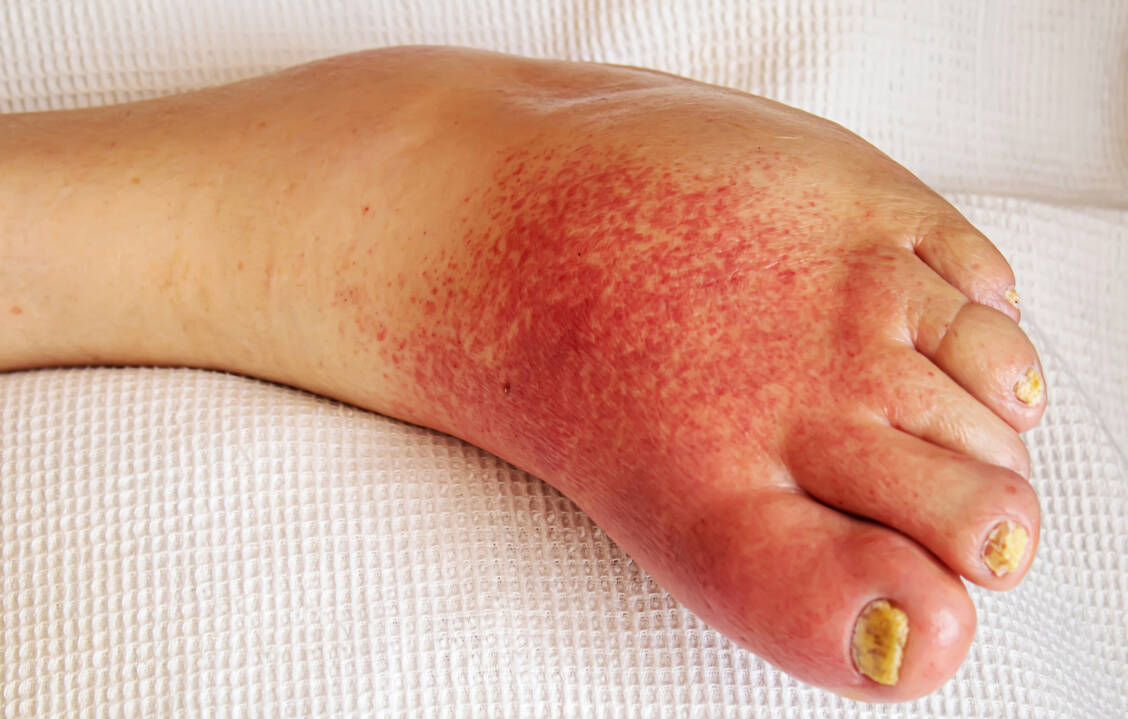 Charakteristisch für ein Erysipel ist eine scharf begrenzte flammenförmige Rötung, die sich zungenförmig ausbreitet. / © Adobe Stock/Milena