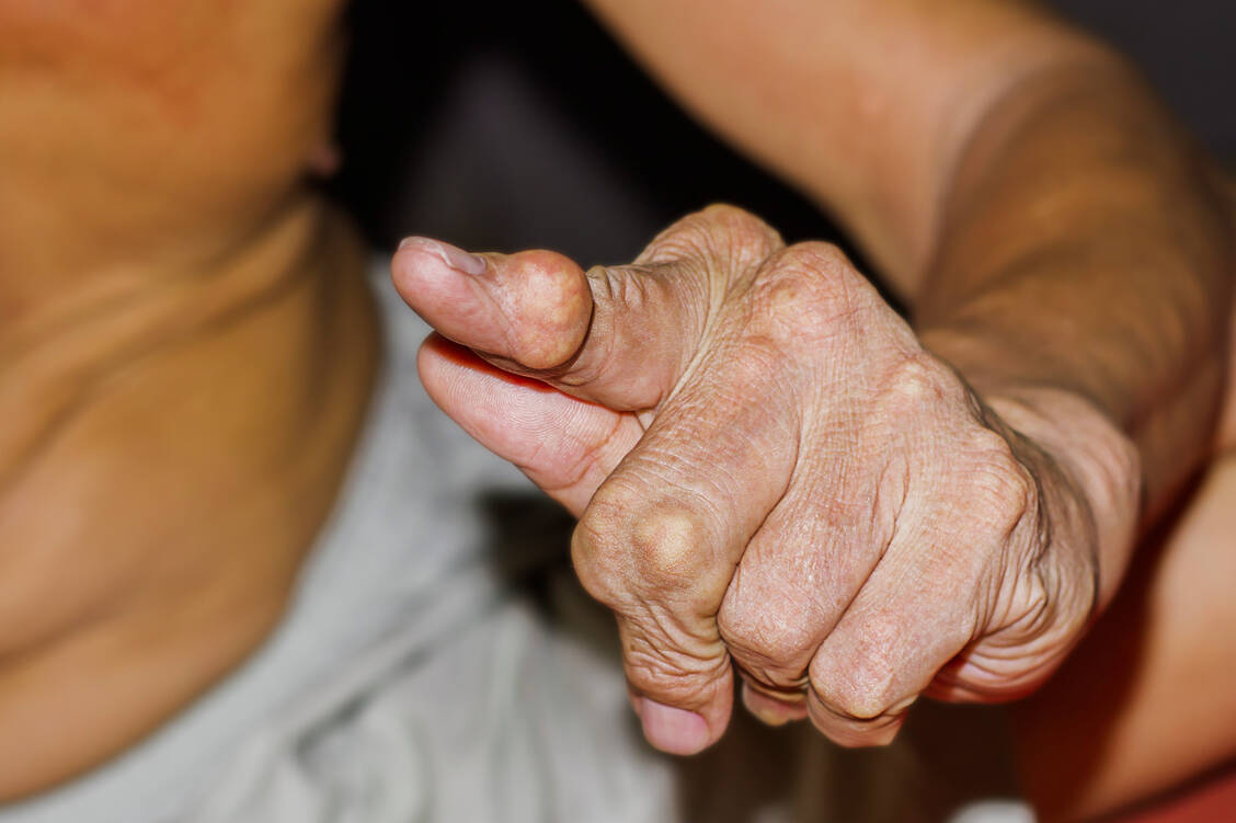 Ablagerungen von Harnsäurekristallen in Gelenknähe (Tophi) vermindern die Beweglichkeit und können zu Gelenkschäden führen. / Foto: Adobe Stock/Adul10