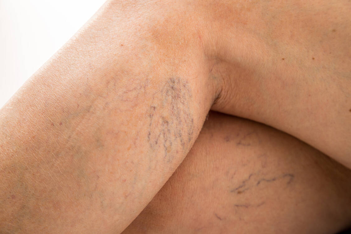 Auch Besenreiser kommen in der Apotheke immer wieder zur Sprache und machen die besondere Beratung und Information erforderlich. / Foto: Adobe Stock/doroguzenda
