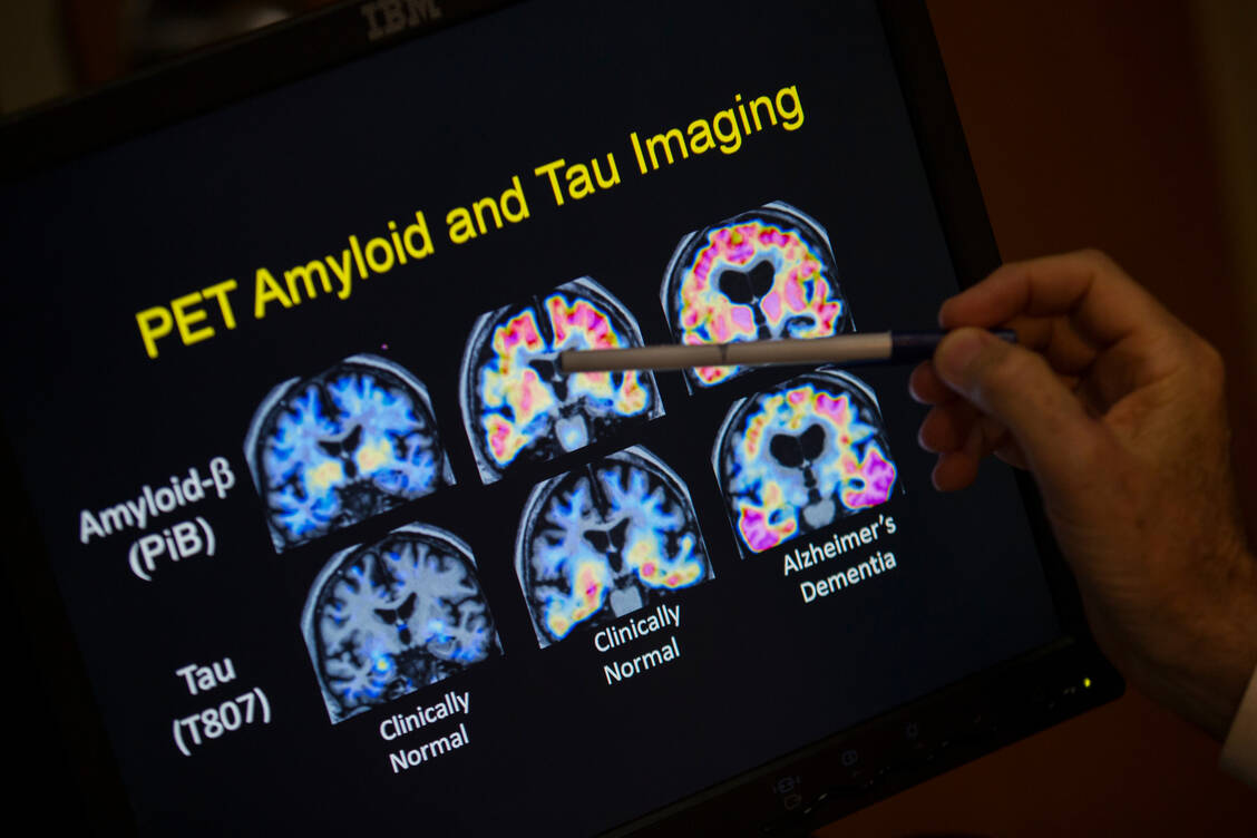 Bei der Alzheimer-Krankheit kommt es typischerweise zu Ablagerungen zweier Peptide im Gehirn: Tau und β-Amyloid. Letzteres ist Target der neuen monoklonalen Antikörper Lecanemab und Donanemab. / Foto: picture alliance / ASSOCIATED PRESS