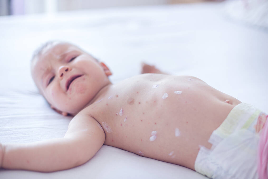 Die Masern zählen zu den ansteckendsten Krankheiten, die es gibt. Eine Infektion mit dem Masernvirus kann zu Komplikationen und ernsten Spätfolgen führen. / Foto: Getty Images/South_agency