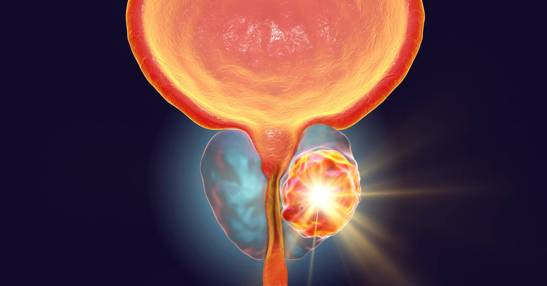 In Deutschland ist Prostatakrebs bei Männern die häufigste Krebserkrankung.  / Foto: Adobe Stock/Dr_Microbe