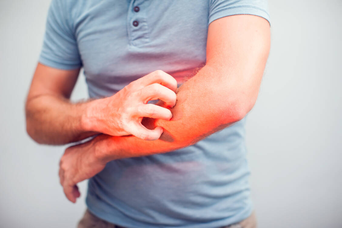 Juckreiz ist eines der quälendsten Symptome einer atopischen Dermatitis und beeinträchtigt Schlaf und Wohlbefinden der Patienten erheblich.   / Foto: Adobe Stock/Aleksej