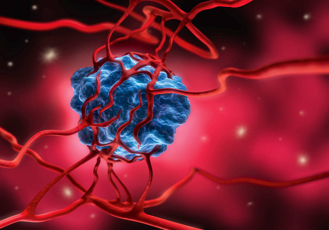 Das Protein TIMP1 fördert die Metatstasierung und kann darüber die Krebssterblichkeit erhöhen.  / Foto: psdesign1/Fotolia