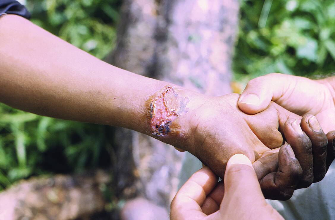 Eine Leishmaniose-Läsion am Handgelenk. / Foto: CDC/Dr. A.J. Sulzer