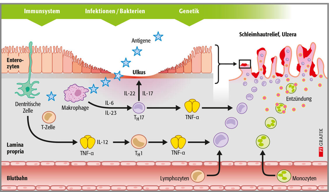 Abbildung 1: Durch die defekte Epithelbarriere (oben Mitte) dringen Antigene in die Lamina propria ein und induzieren eine komplexe Aktivierungskaskade der zellulären Immunabwehr. / © PZ/Stephan Spitzer