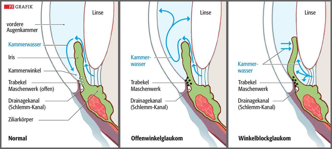 Die Konfiguration des Kammerwinkels unterscheidet sich je nach Glaukomform. / © PZ/Stephan Spitzer