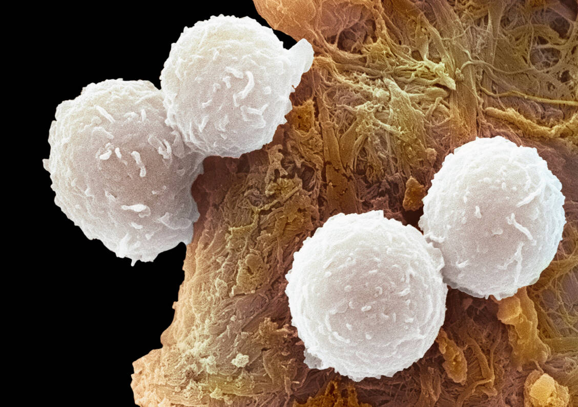 Ein einzelner entarteter B-Lymphozyt vermehrt sich beim Multiplen Myelom stark und verdrängt andere blutbildende Zellen aus dem Knochenmark. / Foto: Getty Images/Science Photo Library/Seve Gschmeissner
