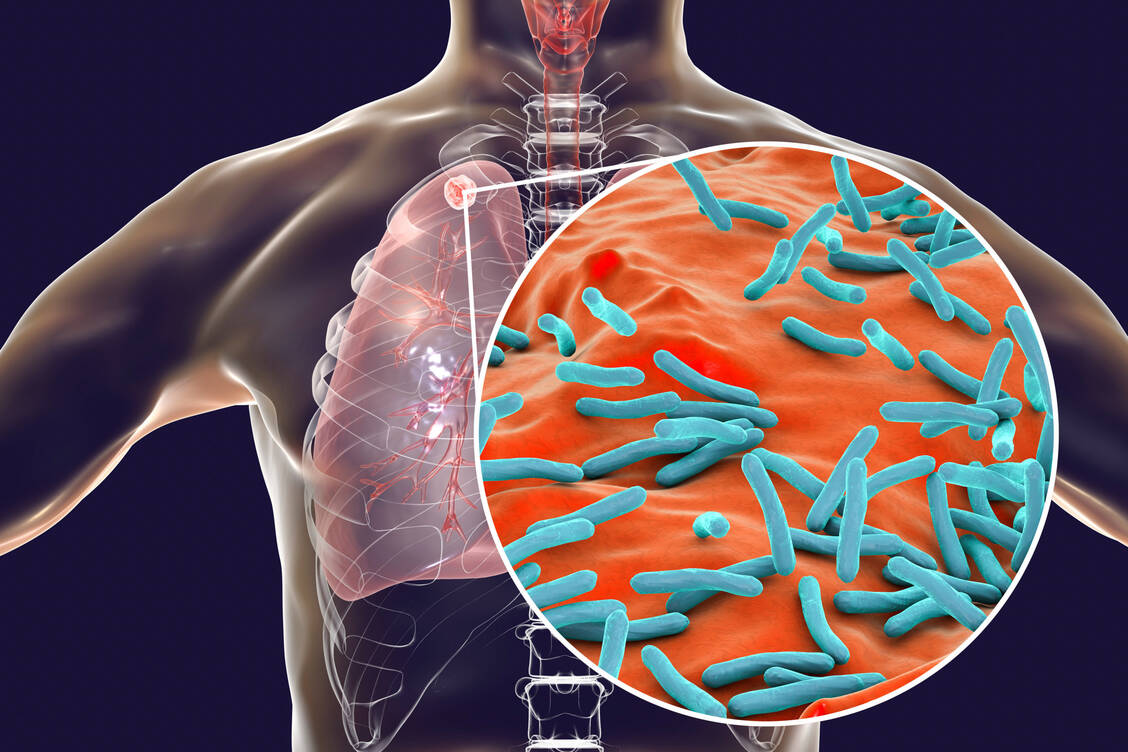 Mehr als eine Million Menschen sterben jedes Jahr an einer Infektion mit Mycobacterium tuberculosis. Damit ist die Tuberkulose die bakterielle Infektionskrankheit mit den meisten Todesopfern weltweit. / © Adobe Stock/Dr_Microbe