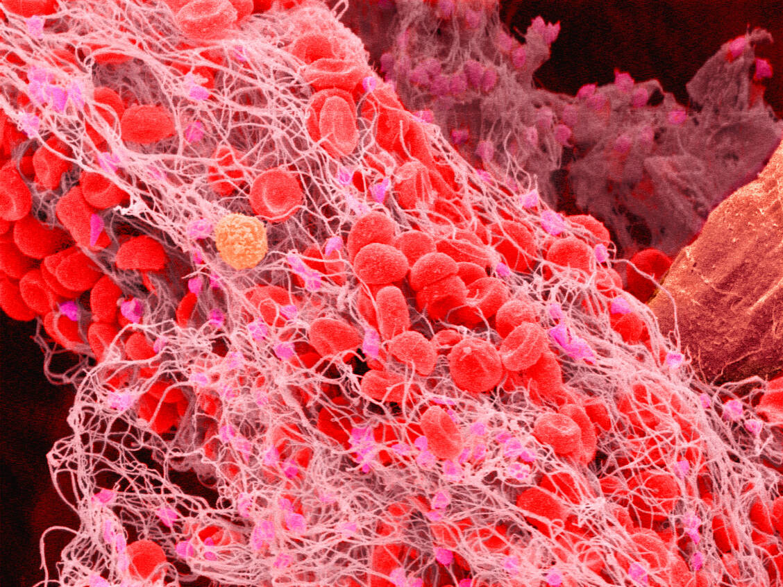 Arterielle Thromben bilden sich durch Quervernetzung von Thrombozyten über Fibrinogen. Clopidogrel kann das verhindern. / Foto: Getty Images/Micro Discovery
