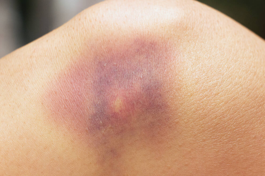 Häufig auftretende blaue Flecken können Anzeichen für eine gestörte Blutgerinnung sein. / Foto: Adobe Stock/thongsee