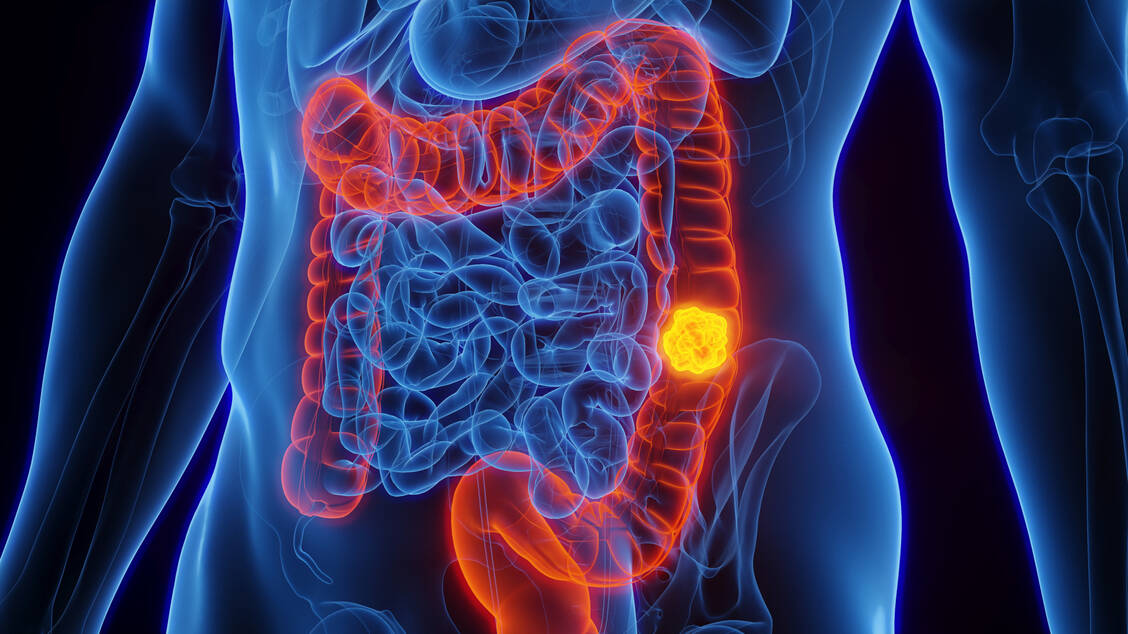 Die häufigste Krebsart im Darm ist das kolorektale Karzinom. / Foto: Getty Images/Science Photo Library