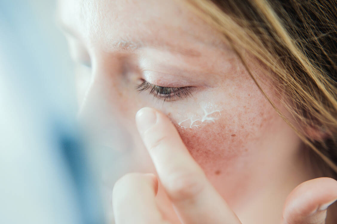 Eine Rosacea kann auch die Augen in Mitleidenschaft ziehen. Die Symptome sind oft unspezifisch wie bei einer Bindehaut- oder Augenlidentzündung. / © Getty Images/Guido Mieth
