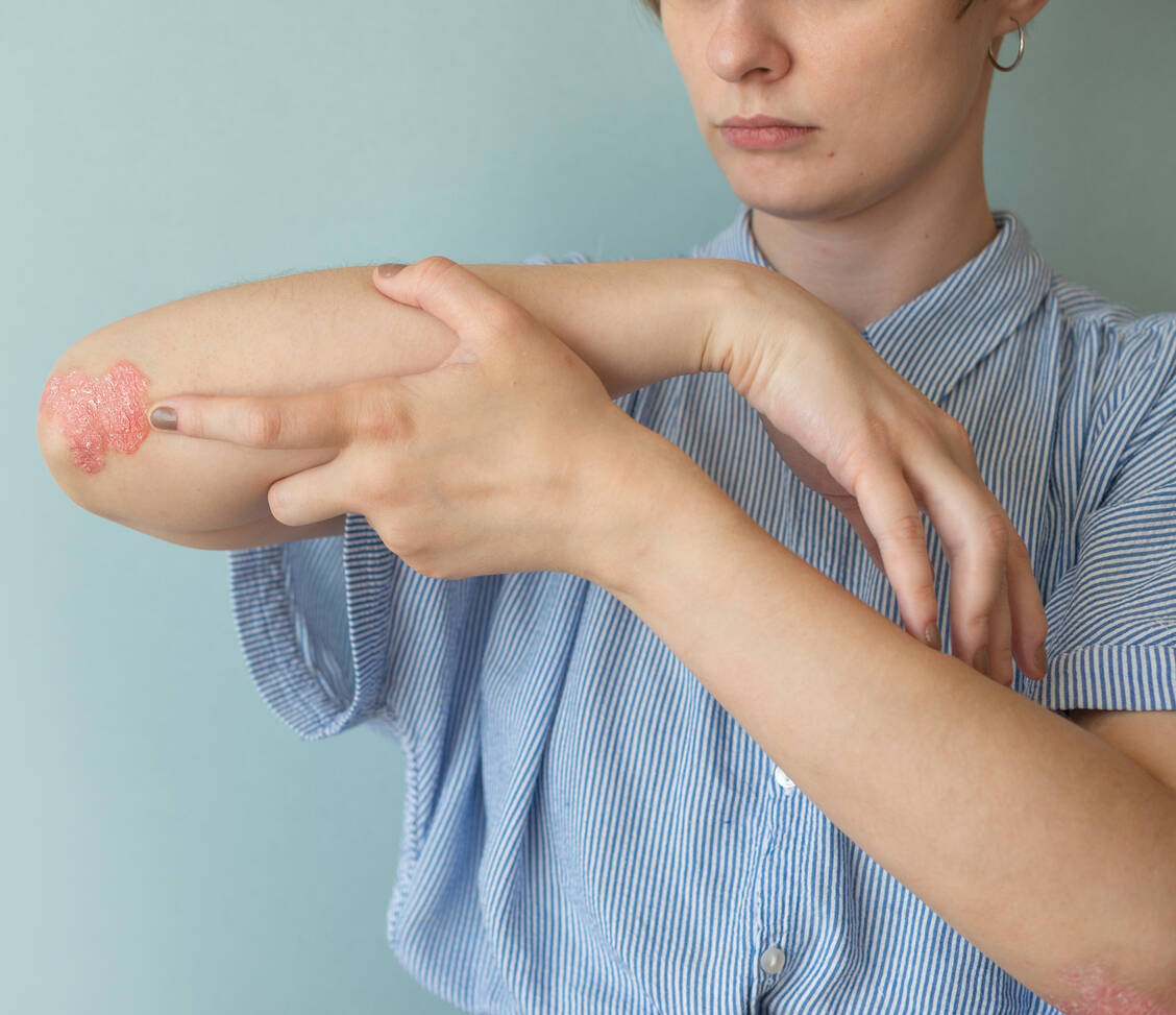 Psoriasis ist eine immunvermittelte Erkrankung. Bis zu 90 Prozent der Betroffenen leiden an Psoriasis vulgaris, auch Plaque-Psoriasis genannt, die gekennzeichnet ist durch ausgeprägte runde oder ovale Hautläsionen, typischerweise bedeckt mit silbrig-weißen Schuppen. / Foto: Adobe Stock/Maria