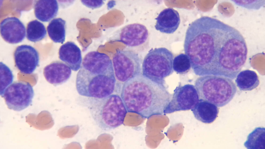 Myelom-Zellen in unterschiedlicher Ausreifung (blau/violett) in einem Knochenmarkausstrich. / Foto: Universitätsklinikum Heidelberg