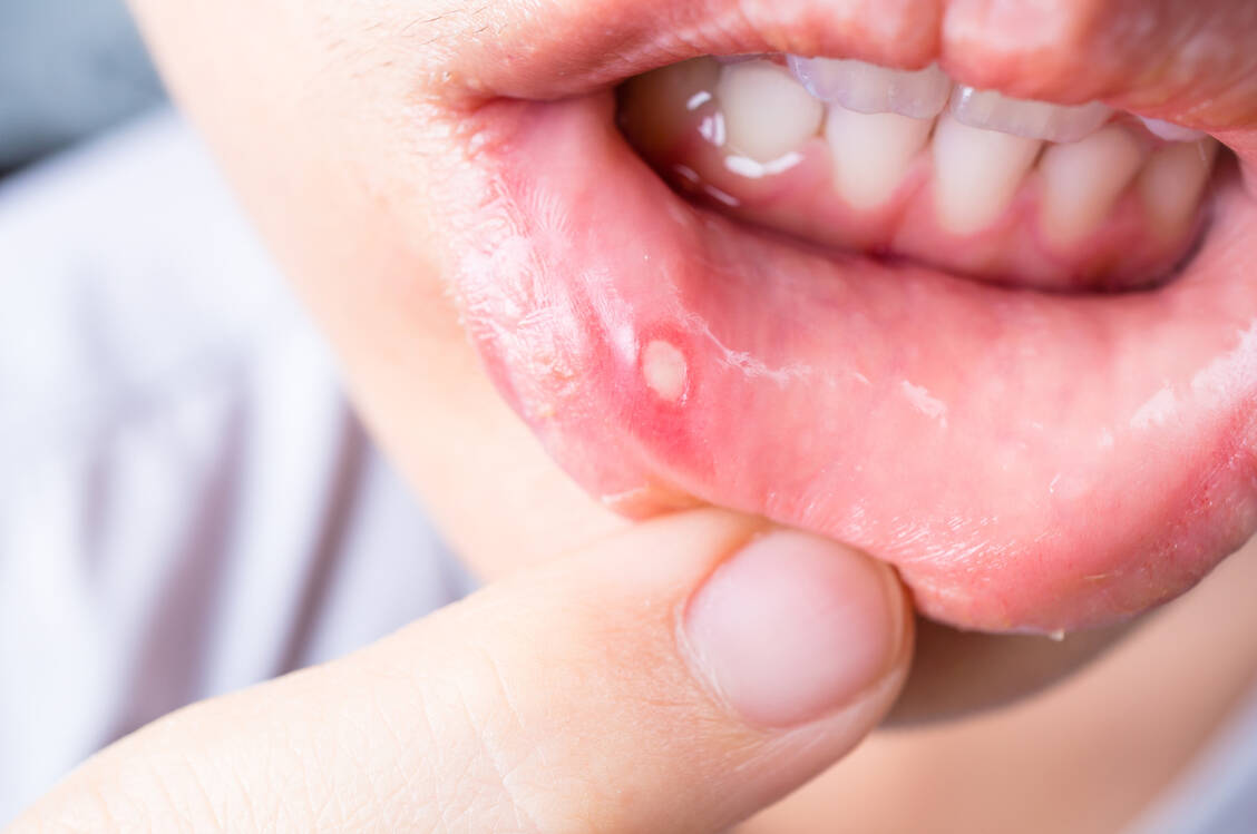 Aphthen sind schmerzhafte Schleimhautdefekte der Mundschleimhaut.Ursächlich behandeln lassen sie sich nicht, aber das OTC-Segment bietet zahlreiche Optionen zur Linderung. / Foto: Adobe Stock/Jaksuthep Teekul