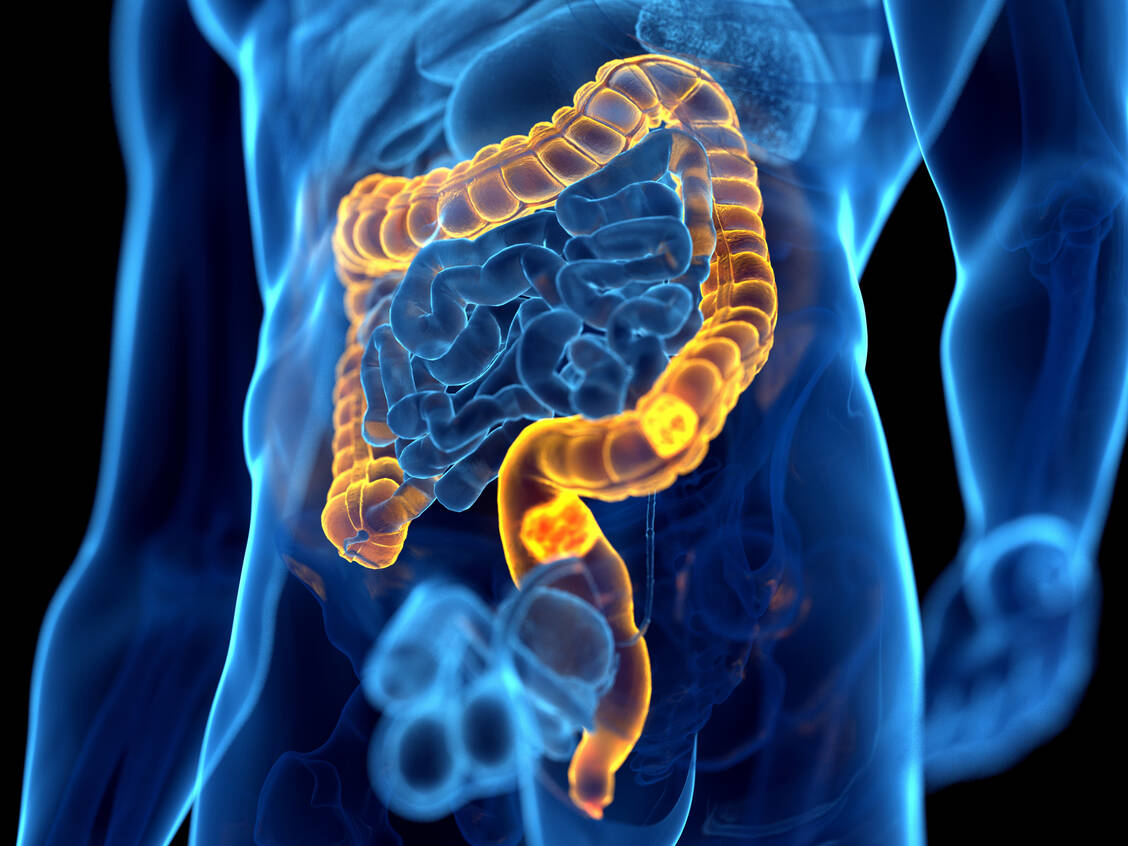 Forschende erzielten mit der gleichzeitigen Blockade mehrerer Signalwege im Maus- und Tumormodell Erfolge bei einer häufigen Darmkrebsart. / © Getty Images/Sebastian Kaulitzki/Science Photo Library