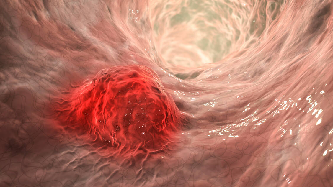 Das kolorektale Karzinom gehört zu den immunologisch vergleichsweise »kalten« Tumoren. Seine Mikroumgebung kann immunsuppressiv wirken, und viele dieser Tumoren reagieren nur unzureichend auf Immuntherapien. / © Getty Images/Science Photo Library/Kateryna Kon