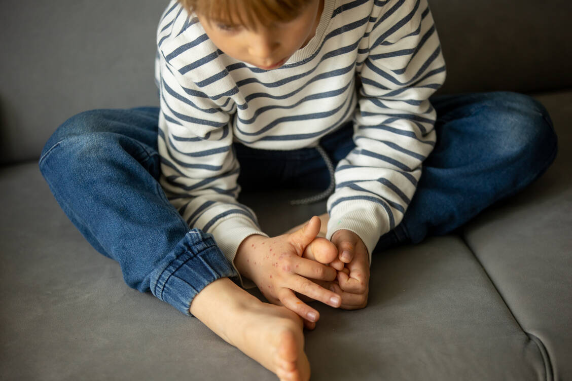 Die Hand-Fuß-Mund-Krankheit bekommen vor allem Kinder. Ihr Name kommt vom charakteristischen Hautausschlag, der vor allem im Mund sowie an Händen und Füßen auftritt. / © Getty Images/tatyana_tomsickova