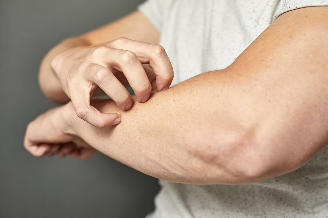 Interleukin-31 wird manchmal auch als »Pruritus-Zytokin« bezeichnet. Es ist wahrscheinlich für verschiedene Krankheitsmechanismen bei atopischer Dermatitis und Prurigo nodularis verantwortlich. / Foto: Adobe Stock/Maria Fuchs