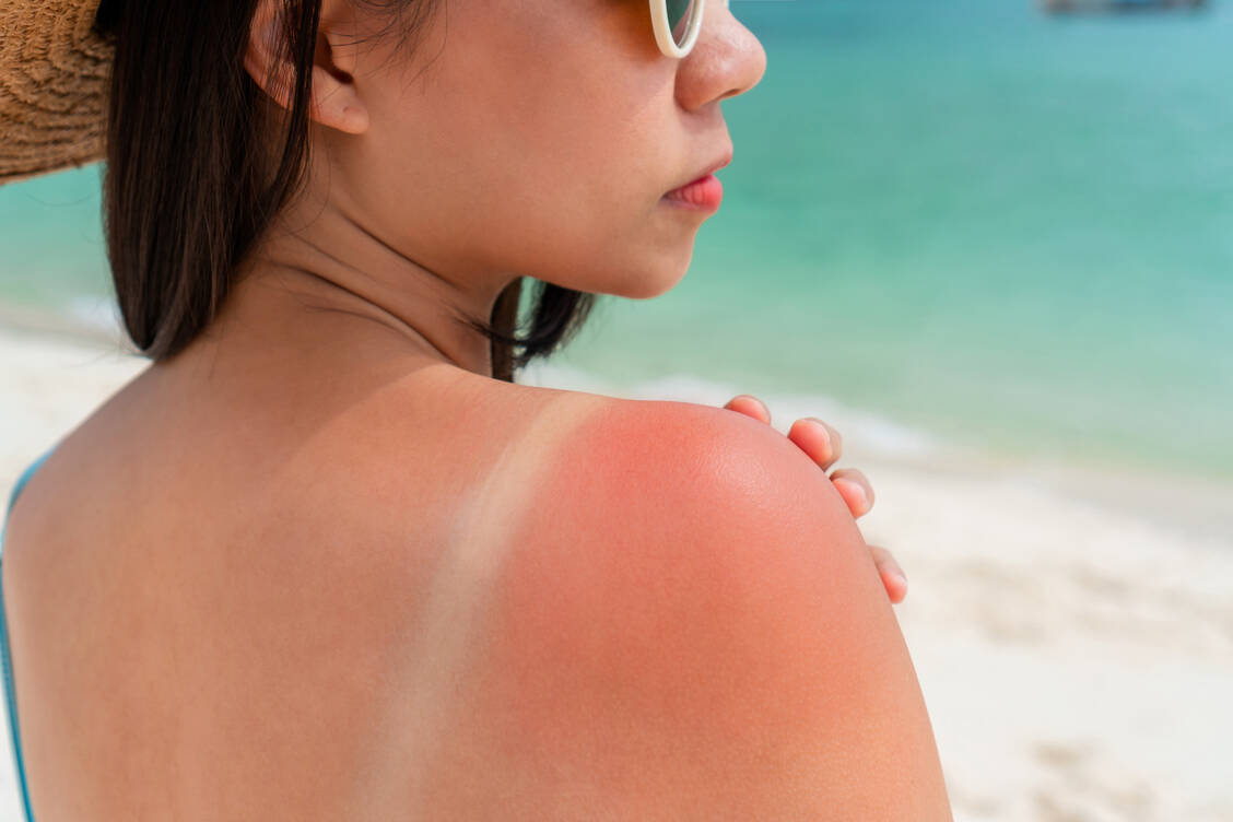 Gerötet, warm und schmerzend – ein Sonnenbrand ist die Akutreaktion auf zu hohe UV-Strahlungsdosen. Die Reaktion wird neuen Erkenntnissen zufolge durch mRNA-Schäden ausgelöst.  / © Getty Images/Pattarisara Suvichanarakul
